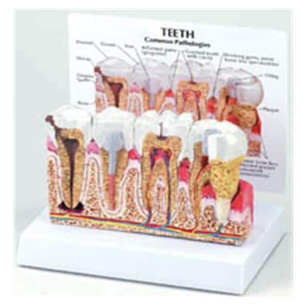 Patient Education Model Diseased Teeth & Gum 6 in x 6 in x 5.5 in Ea