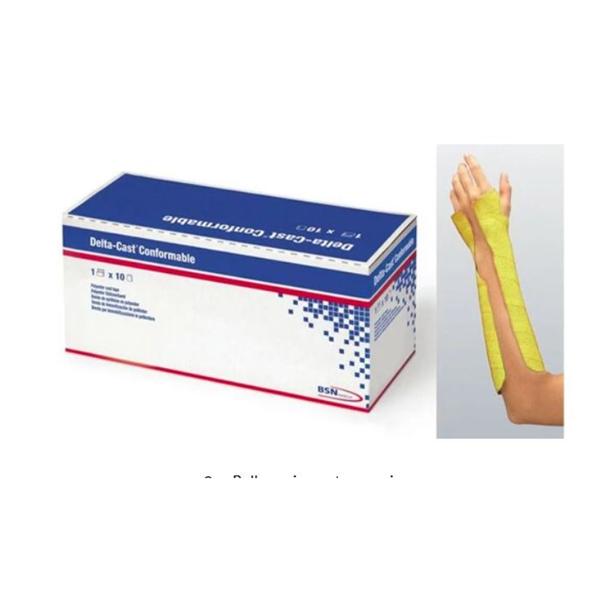 Delta-Cast Prelude Splint System